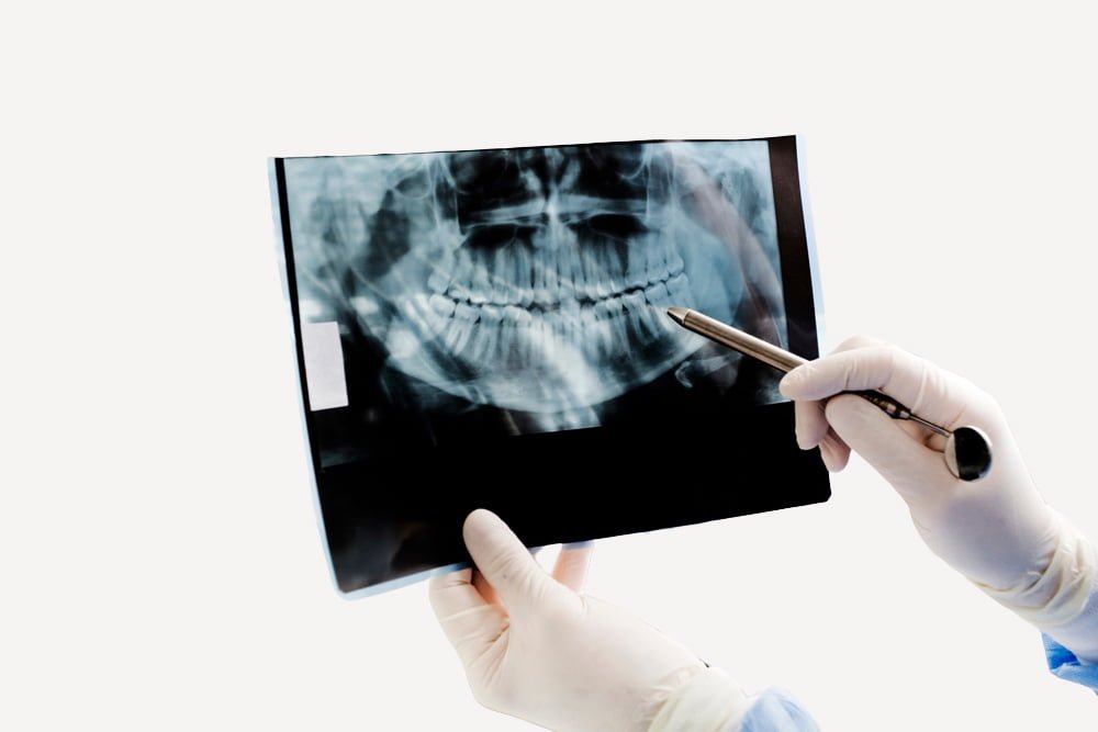 Dental X-Ray