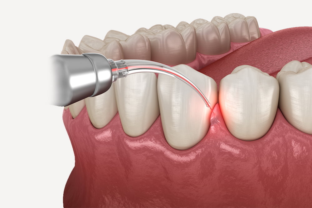 Gum Disease