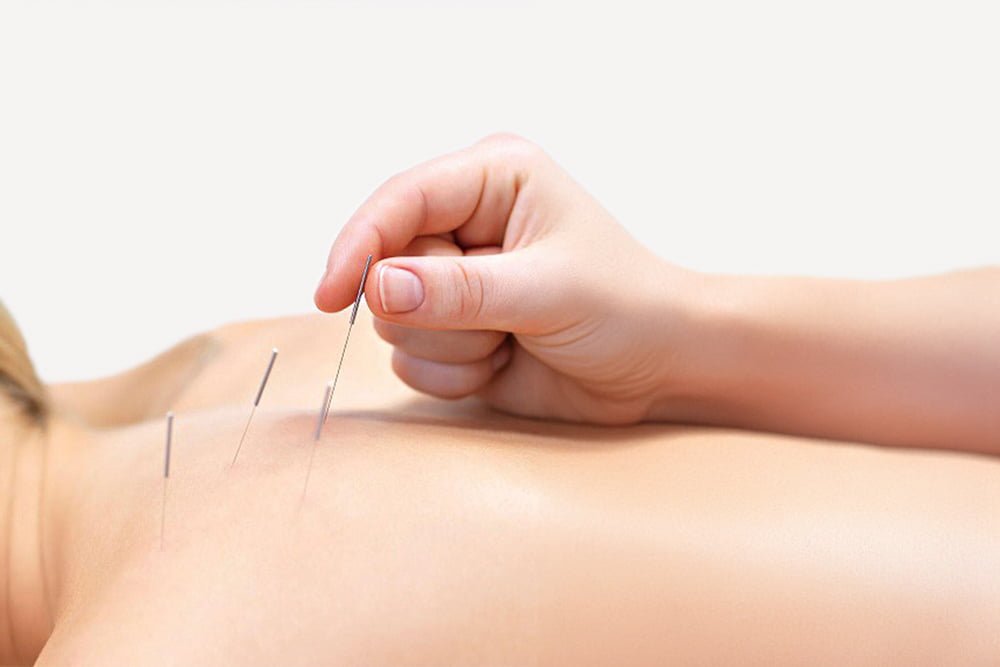 Dry Needling