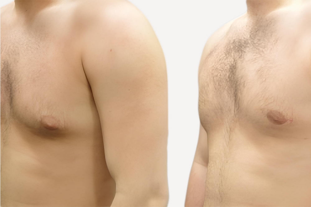 Gynecomastia