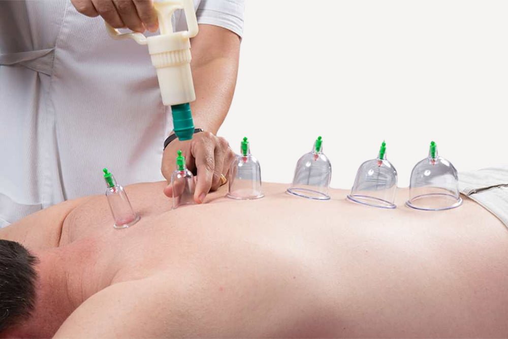 Sports Cupping