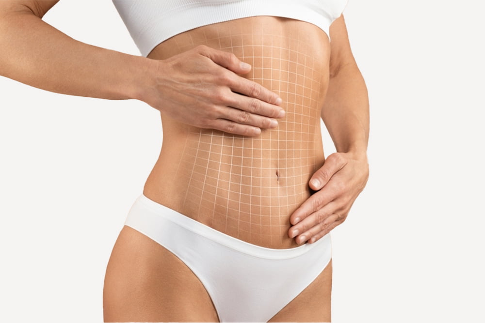 Tummy Tuck