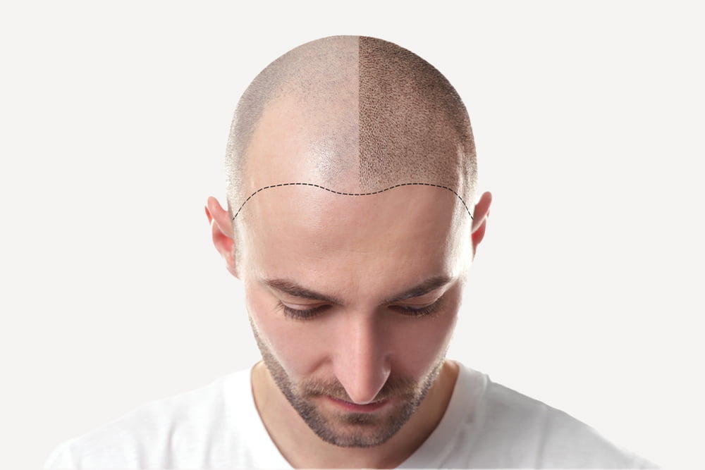 Hair Transplant