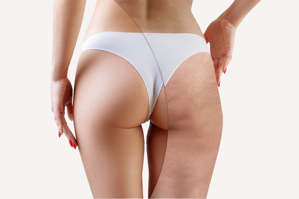 Cellulite Treatment