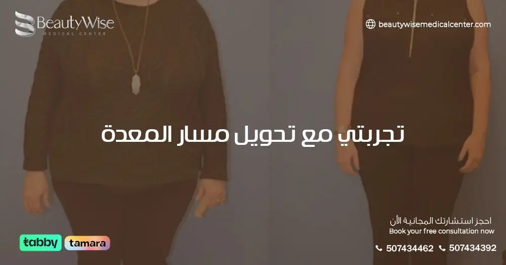 تجربتي مع تحويل مسار المعدة