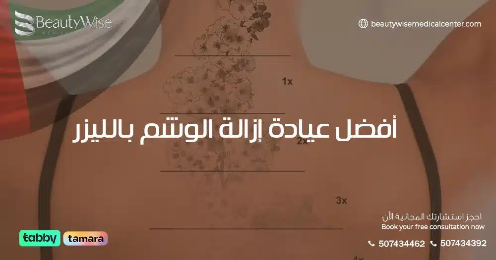 أفضل عيادة لإزالة الوشم بالليزر