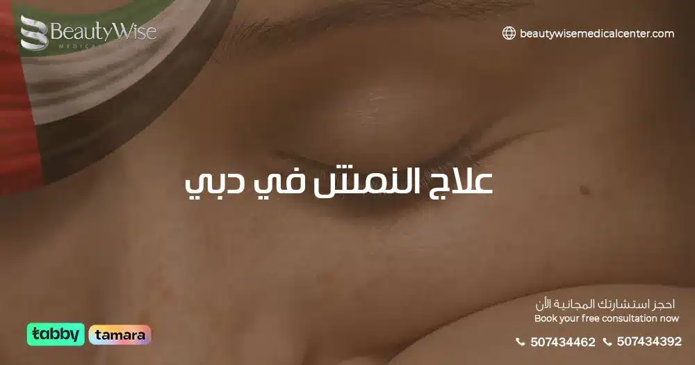 علاج النمش في دبي