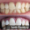 Teeth Cleaning 02