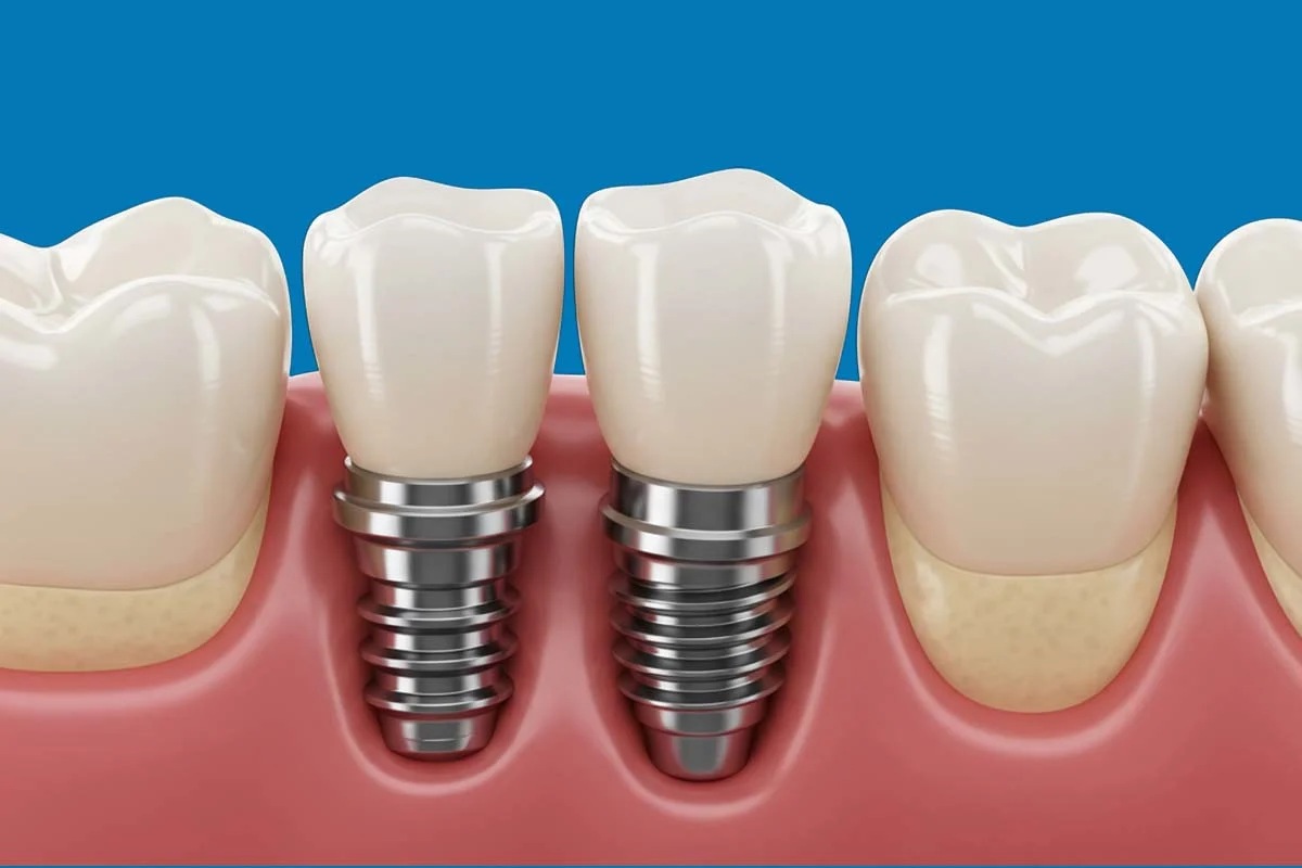 عيادة زراعة الأسنان في الامارات