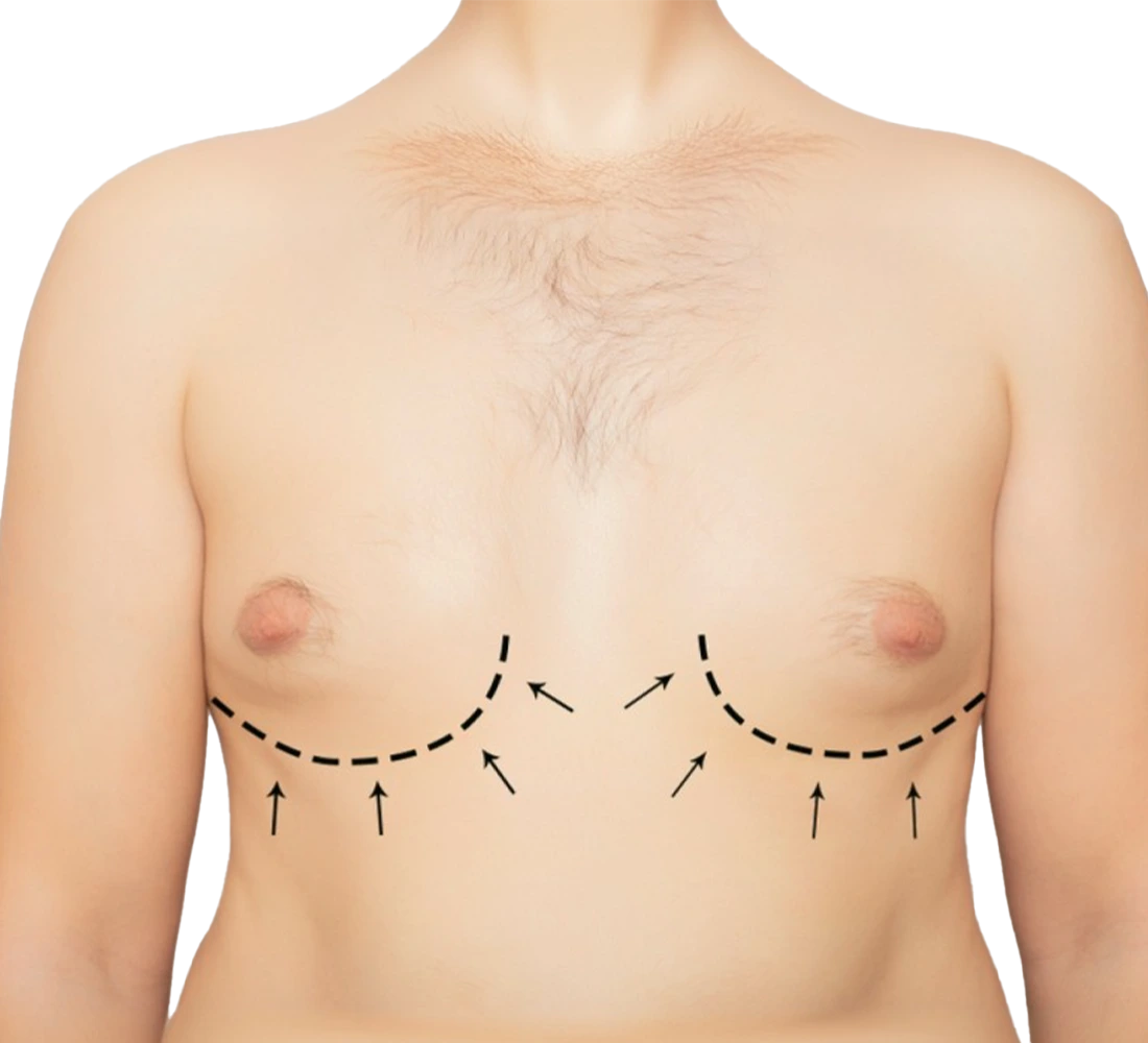 عيادة علاج التثدي في الإمارات