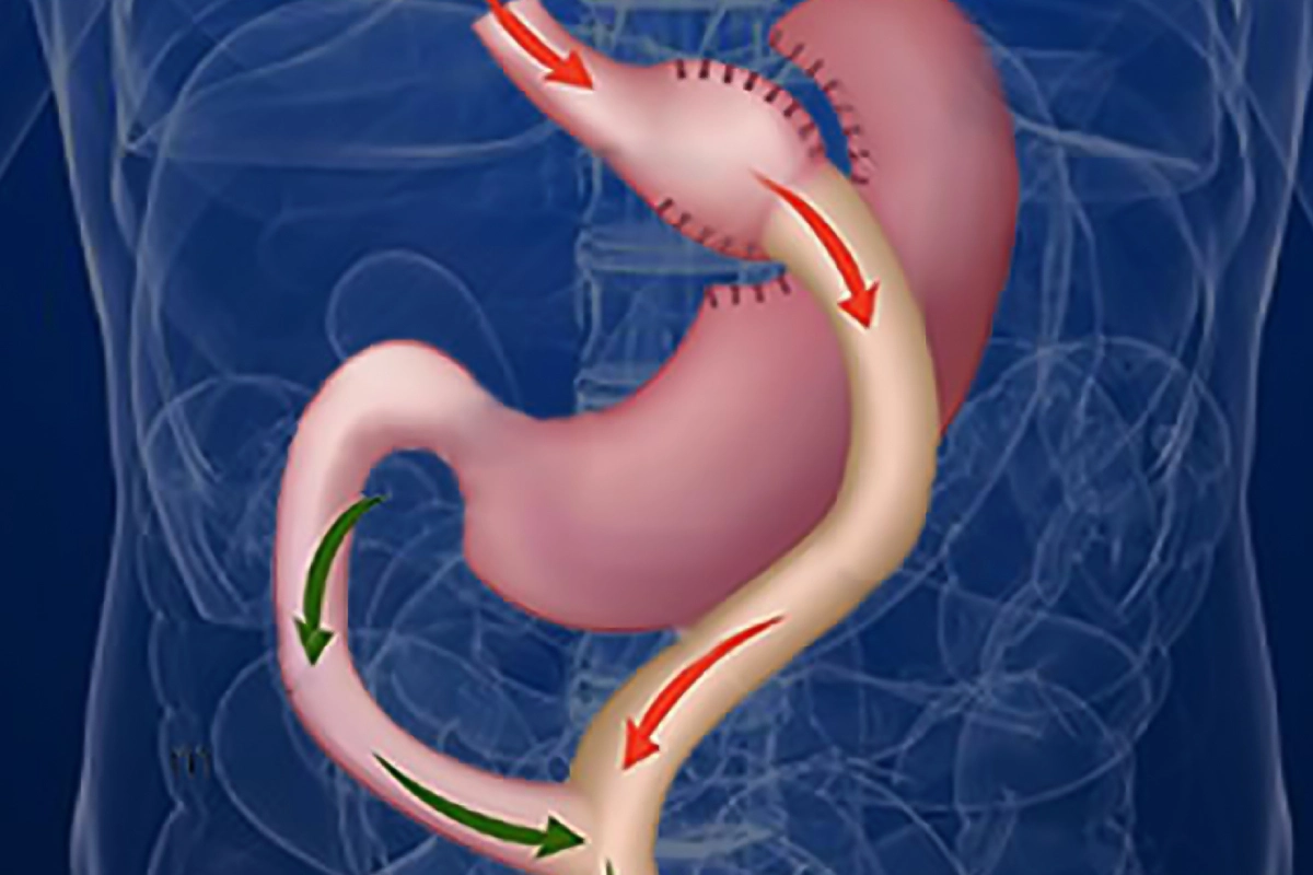 عملية تحويل المسار المصغر في الامارات