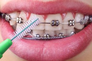 عيادة تنظيف أسنان في دبي