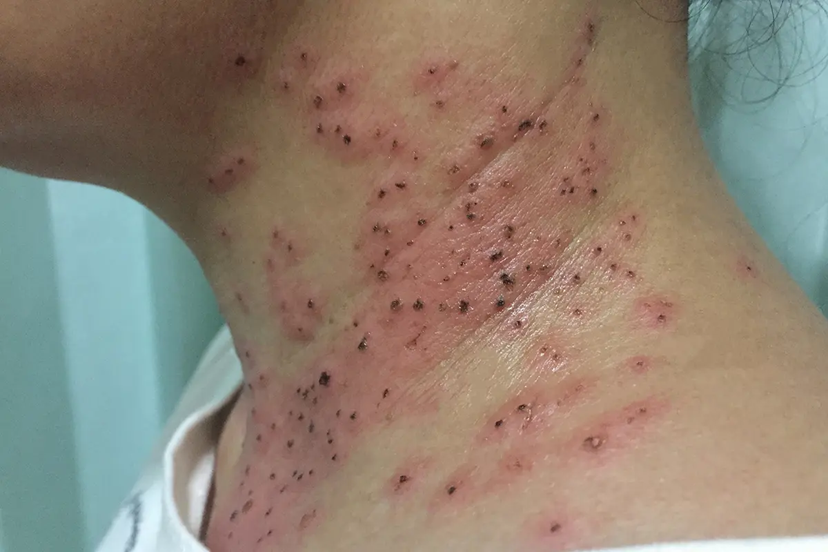 كيفية التخلص من النمش