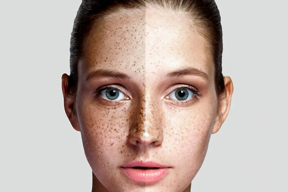 كيفية التخلص من النمش