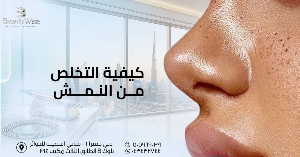 كيفية التخلص من النمش
