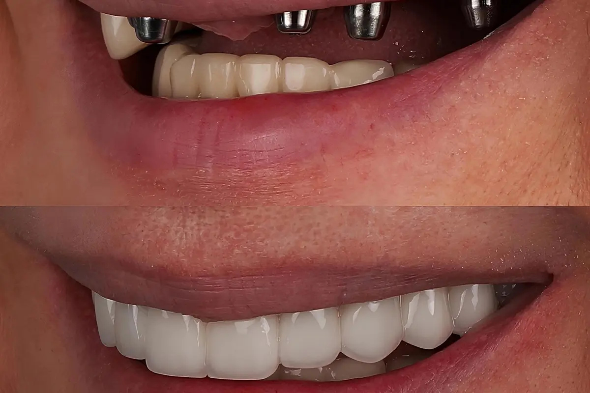 كيفية زراعة الأسنان في الامارات