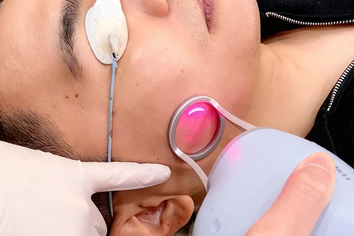 ازالة النمش بالليزر في دبي