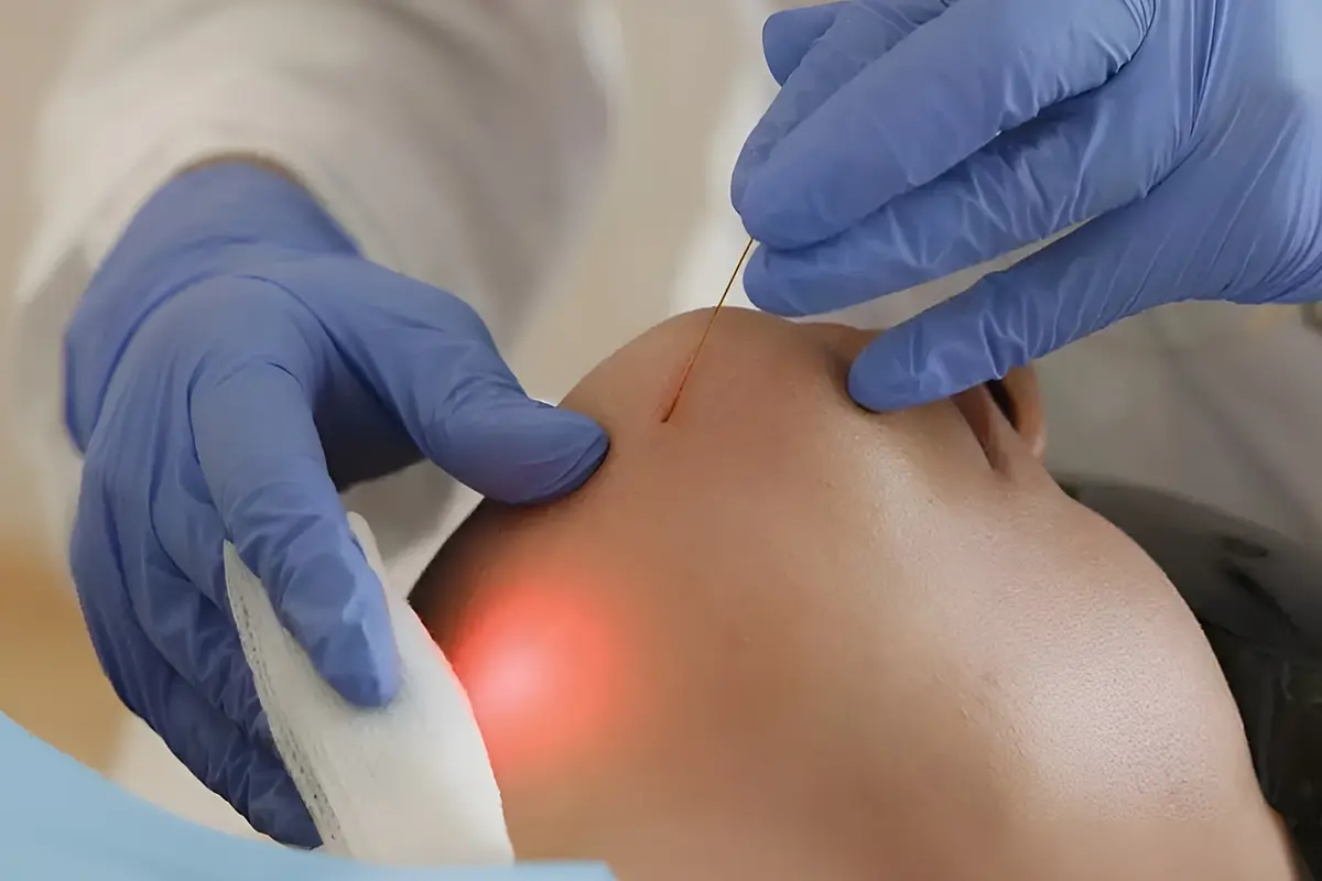 ما هي تقنية الاندوليفت؟