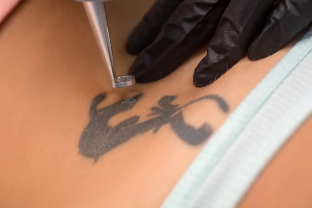 Tattoo Removal Clinic in the UAE