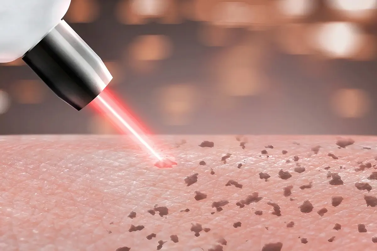 ازالة النمش بالليزر في دبي