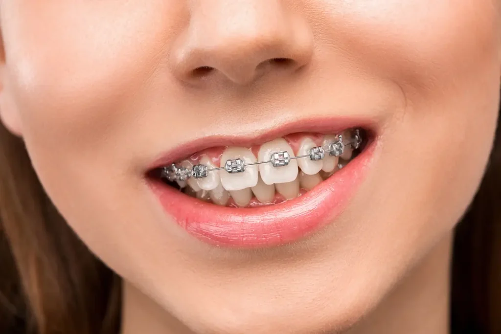 اسعار تقويم الاسنان في دبي