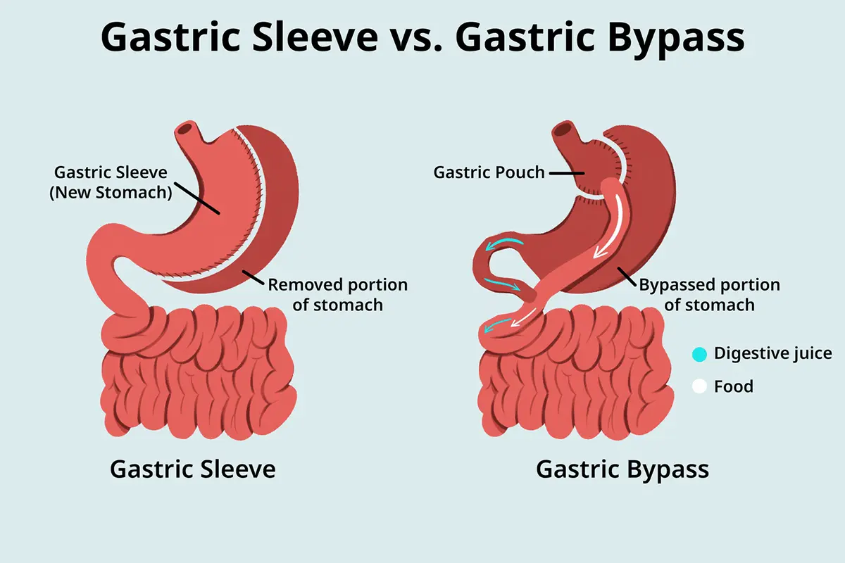 الفرق بين تدبيس المعدة وتكميم المعدة