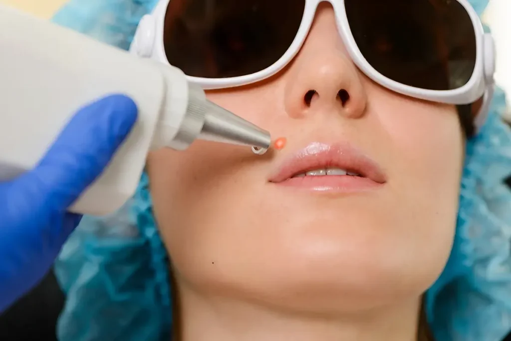 مركز سوفت لايت في الامارات – إزالة الشعر نهائياً وبأمان تام