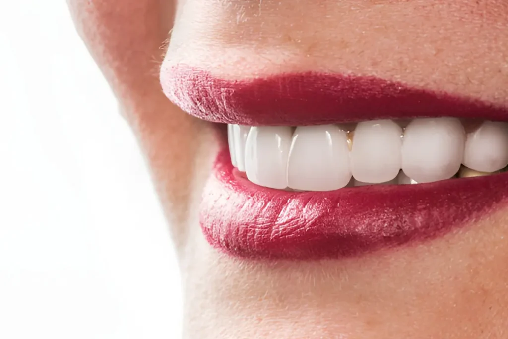 ما هي مميزات الفينير المستخدم في ابتسامة هوليوود؟