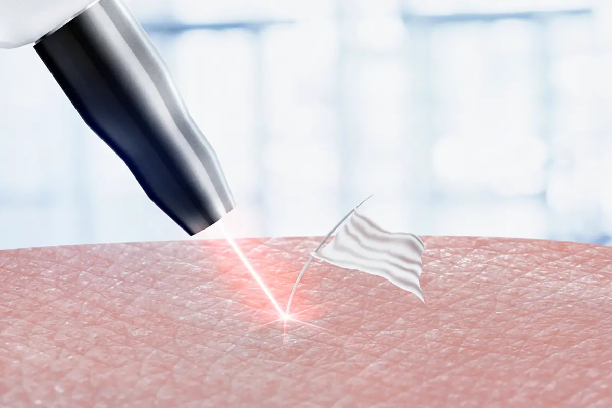 مركز إزالة الشعر الأبيض بالليزر دبي