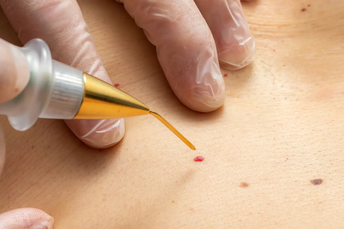 مركز بلازماج الزوائد الجلدية