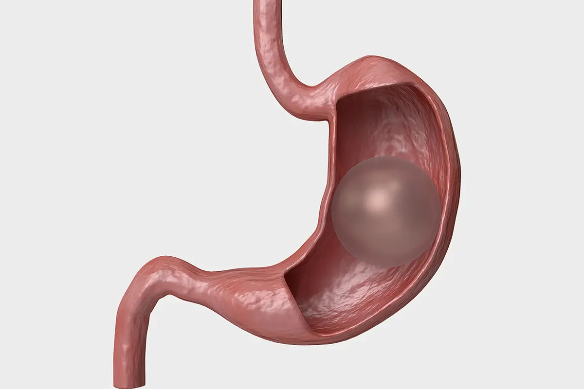 مركز إزالة بالون المنظار في الامارات
