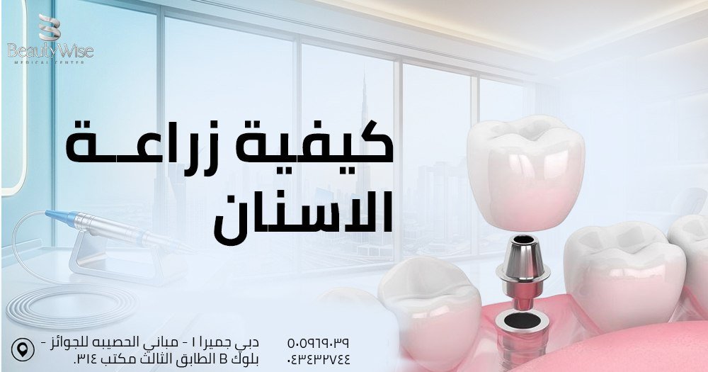 كيفية زراعة الاسنان
