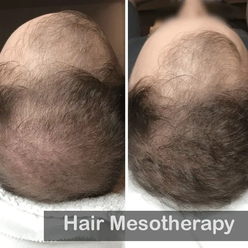 Hair-Mesotherapy-1