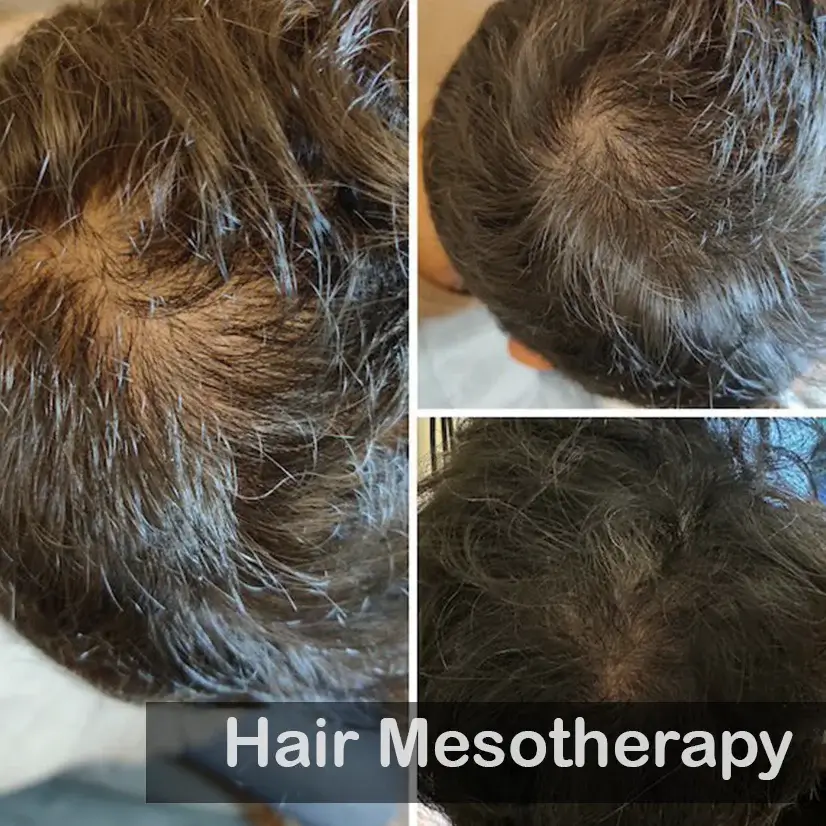 Hair-Mesotherapy