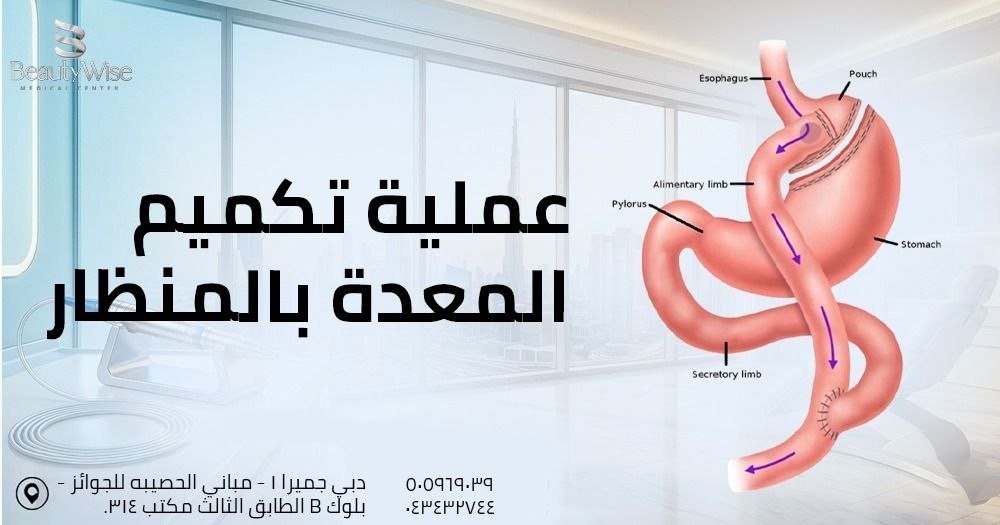 عملية تكميم المعدة بالمنظار