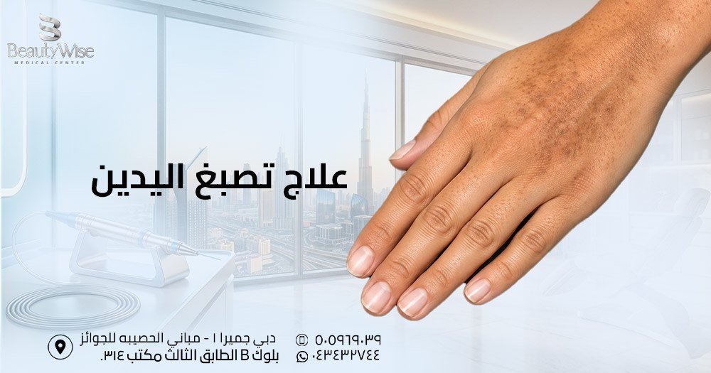 علاج تصبغ اليدين